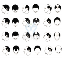 【SG亚洲胜游基因检测】过早<font color='red'>脱发</font>、掉发太多怎么办？你的方法可能是错的！